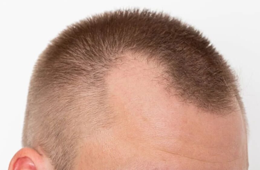 Thinning Hair