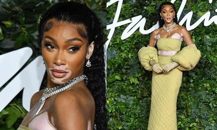 Winnie Harlow Net Worth